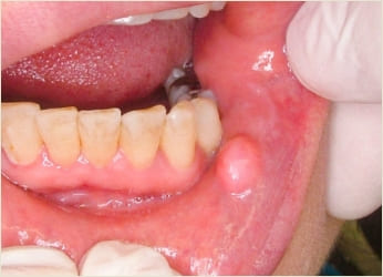 口腔腫瘍